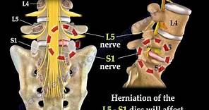 Low Back Pain - Disc Herniation ,Sciatica - Everything You Need To Know - Dr. Nabil Ebraheim