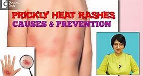 Prickly Heat Summer Rash- Know the Causes & Tips to prevent it? - Dr. Rasya Dixit | Doctors' Circle
