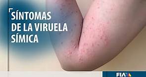 Viruela símica, síntomas y formas de contagio