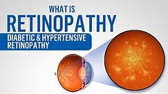 What is Retinopathy | Diabetic retinopathy | Hypertensive retinopathy