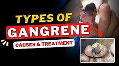Gangrene | Types of gangrene | Causes and Homeopathic Treatment