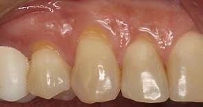 Innova Dental - Verlo en HD Restauración con Composite...