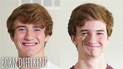 We're Identical Twins - But Only On One Side | BORN DIFFERENT
