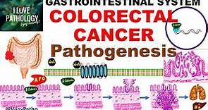 Colorectal carcinoma - Epidemiology, risk factors & Pathogenesis