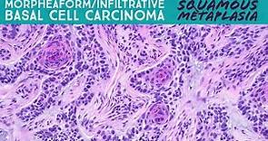 Morpheaform/infiltrative basal cell carcinoma with squamous metaplasia (not squamous cell carcinoma)