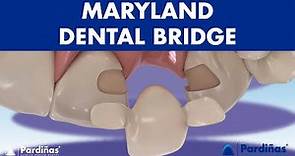 MARYLAND bridge - A DENTAL BRIDGE alternative for missing teeth ©