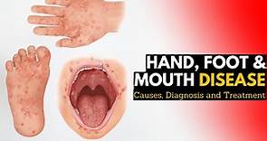 Hand, Foot, and Mouth Disease, Causes, Signs and Symptoms, Diagnosis and Treatment,