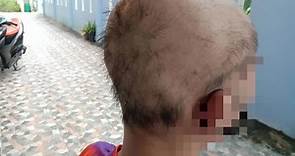 泰國首例！19歲少年打2劑科興疫苗「頭髮狂掉」沒藥醫｜東森新聞