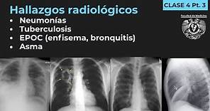 04.3 - Neumonía, TB, EPOC, Enfisema, Bronquitis, Bronquiectasias, Asma