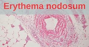 What is Erythema Nodosum? - Pathology mini tutorial