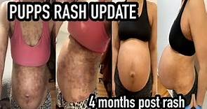 UPDATE PREGNANCY RASH | PUPPS RASH