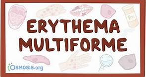 Erythema multiforme - causes, symptoms, diagnosis, treatment, pathology