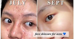 Rekomendasi Skincare utk Jerawat (kombinasi berminyak)