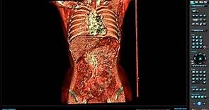 Human body revealed in full by new digital autopsy scanner