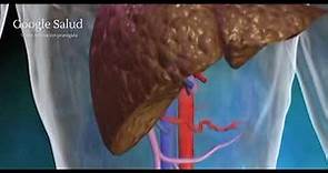 Cáncer de Hígado (Vídeo Animación con tutorial)