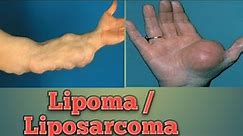 Lipoma | Liposarcoma| Cancer Pathology #Oncology #Cancer