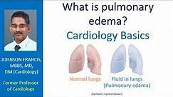 What is pulmonary edema? Cardiology Basics