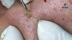 Big Cystic Acne Blackheads Extraction Blackheads & Milia, Whiteheads Removal Pimple Popping S006