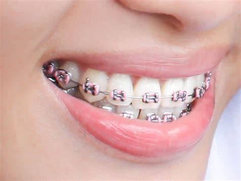 Brace