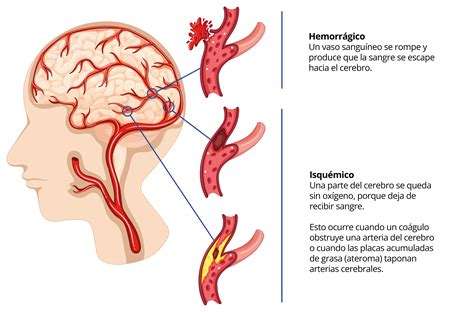 Ictus