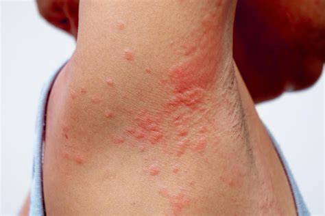 Rash