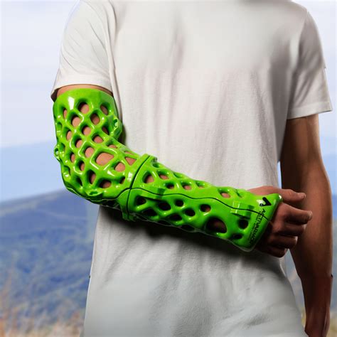 3D Printed Cast