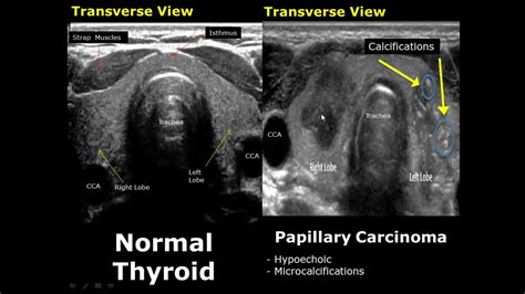 Abnormal Thyroid Ultra… 