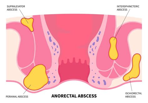 Abses Anus