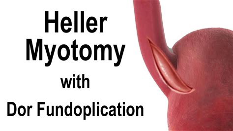 Heller Myotomy