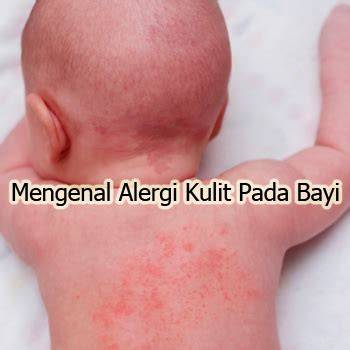Alergi Bayi