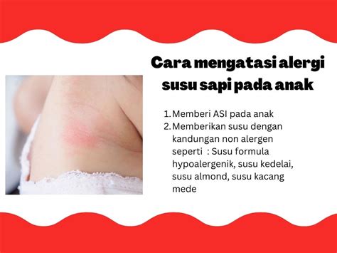 Alergi Susu Sapi