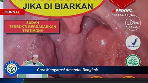 Amandel Bengkak