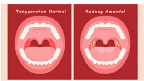 Amandel Radang