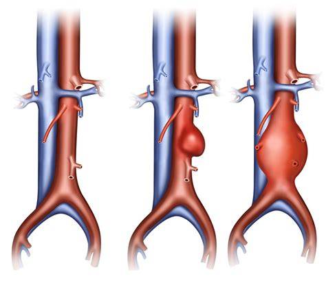 Aneurisma Aorta