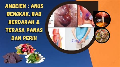 Anus Bengkak