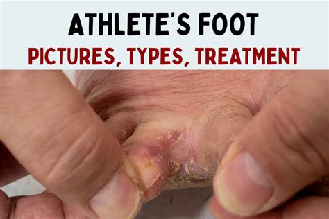 Athlete's Foot
