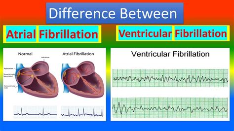 Fibrillation vs Ventricular