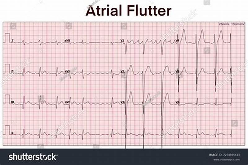 Atrial Flutter Pattern