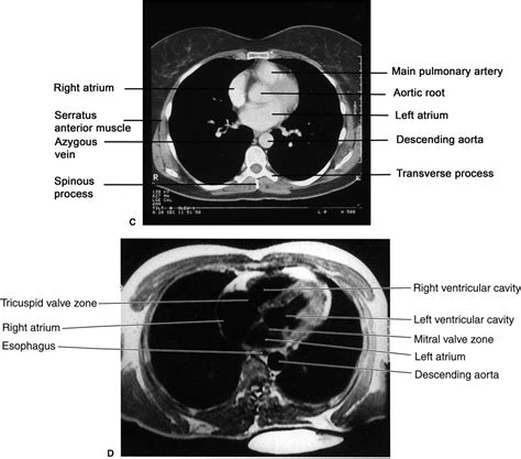 Left Ventricle