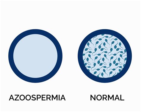 Azoospermia