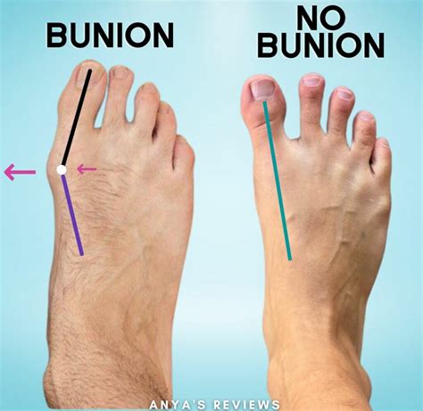 vs Normal Foot