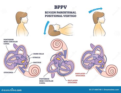 BPPV