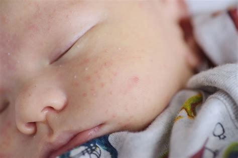 Bayi Bruntusan