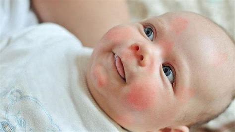Bayi Gatal