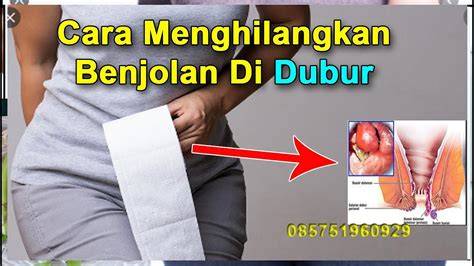 Benjolan di Dubur