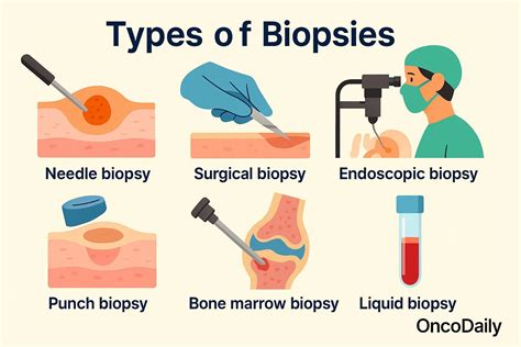 Biopsi Tumor