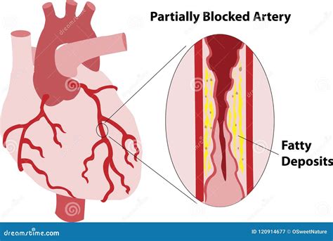 Blocked artery