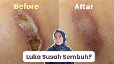Borok Kulit