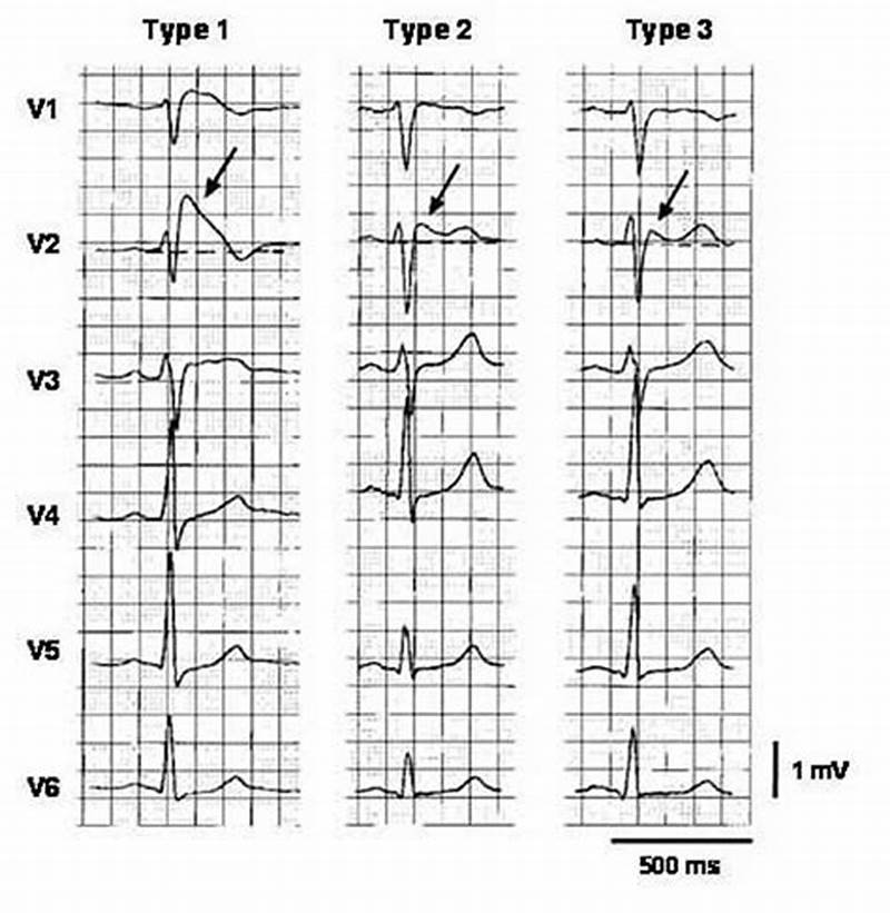 Brugada Pattern Types