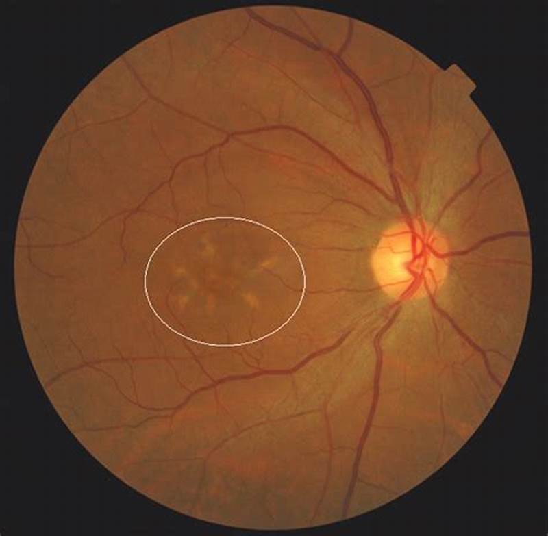 Butterfly Pattern Dystrophy